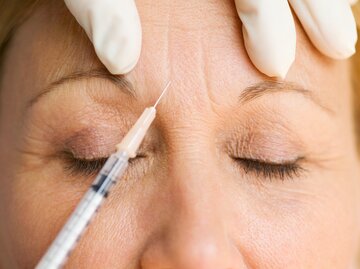 Eine Frau bekommt Botox in ihre Stirnfalten | © GettyImages/Rick Gomez
