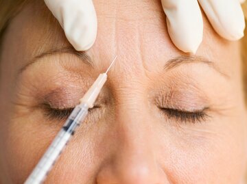 Eine Frau bekommt Botox in ihre Stirnfalten | © GettyImages/Rick Gomez