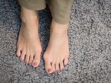 Füße einer Frau mit Hallux Valgus | © GettyImages/Jatuporn Tansirimas
