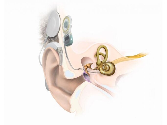 Modernste Medizintechnik: Beim Einsatz eines Cochlea-Implantats wird eine feine Elektrode in die Hörschnecke eingesetzt, die den Hörnerv stimuliert.
 | © MED-EL
