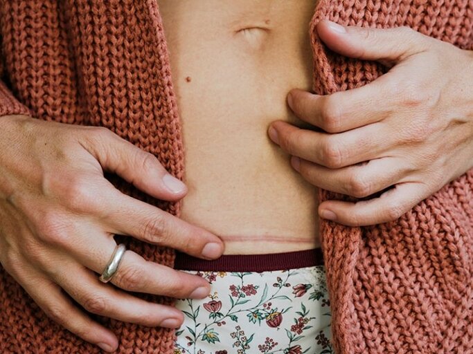 Eine Kaiserschnittnarbe empfinden viele Frauen als störend. Spezielle Methoden der ästhetischen Medizin helfen dabei, das vernarbte Gewebe zu korrigieren. | © Getty Images | Westend61